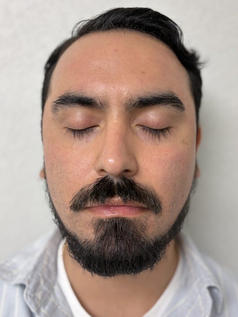 01-after Aerolase Laser