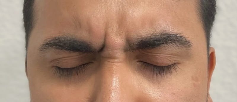 botox, xeomin, dysport 01-antes
