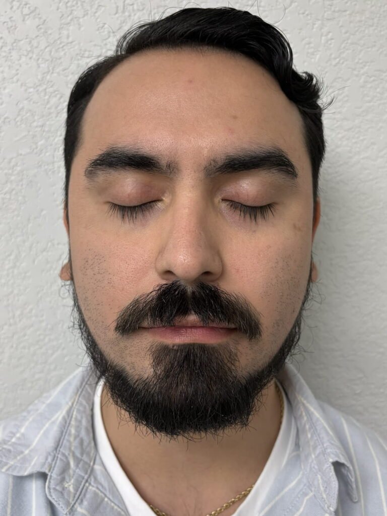 01-before Aerolase Laser