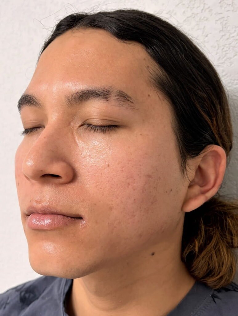 01-despues de Secret Rf PRP Vip Peel Aerolase
