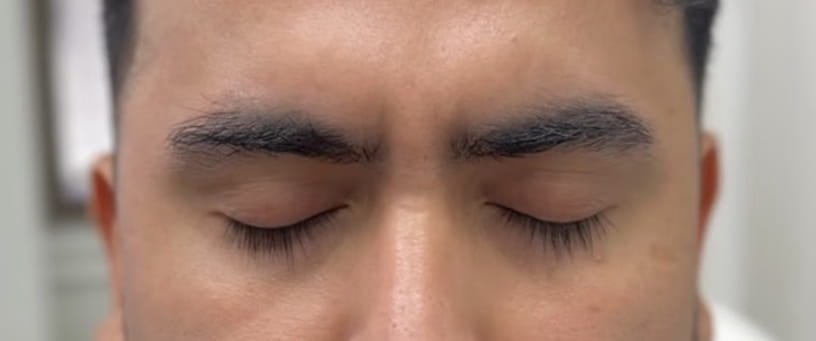 01-despues botox, xeomin, dysport