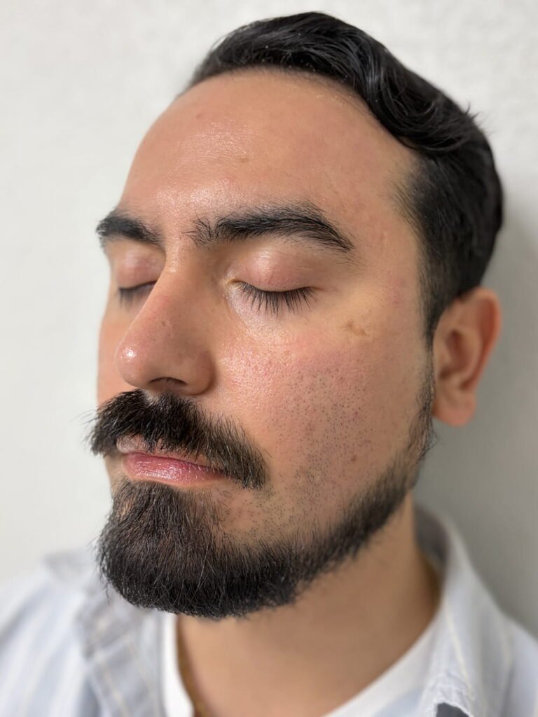 Tratamiento con Aerolase Laser