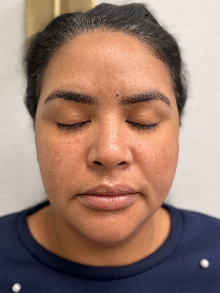 02-antes PRP aerolase adva vi peel