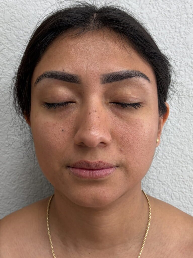 02-antes Face balance with plasma gel