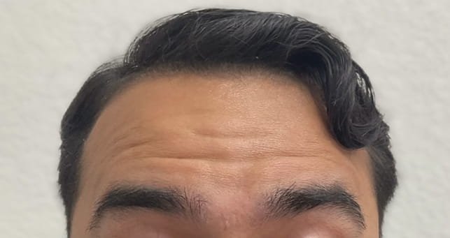 02-antes Botox, xeomin, dysport