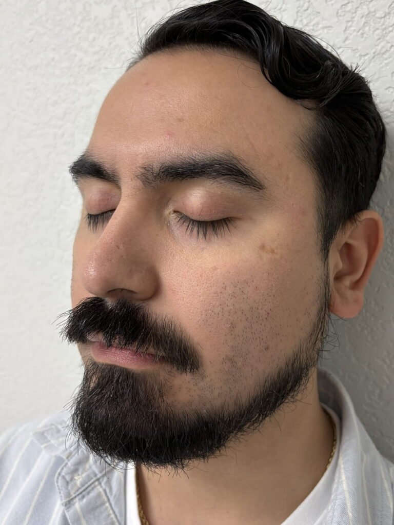 02-before Tratamiento con Aerolase Laser