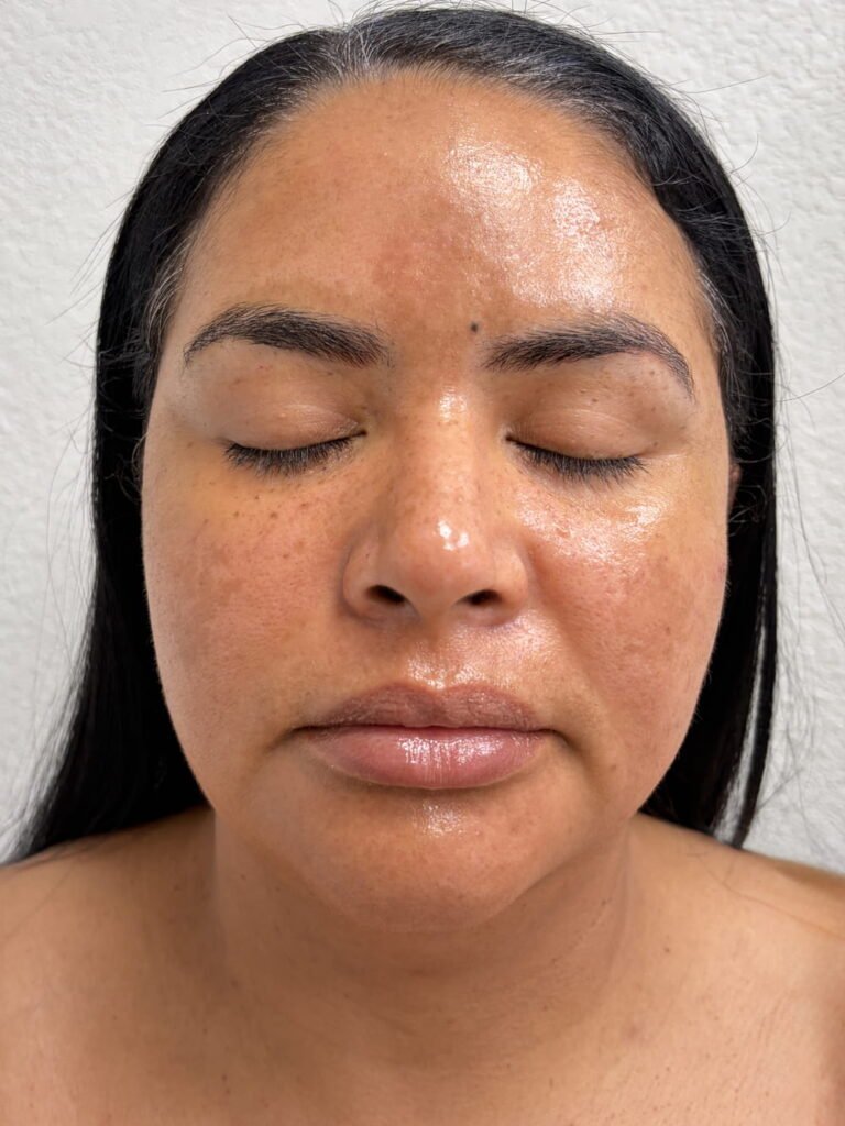 PRP aerolase adva vi peel