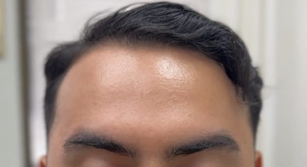 Botox, xeomin, dysport