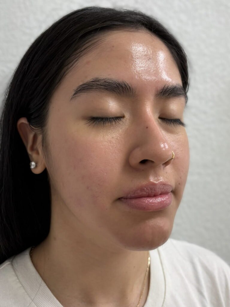 03-after signature facial chemical peel