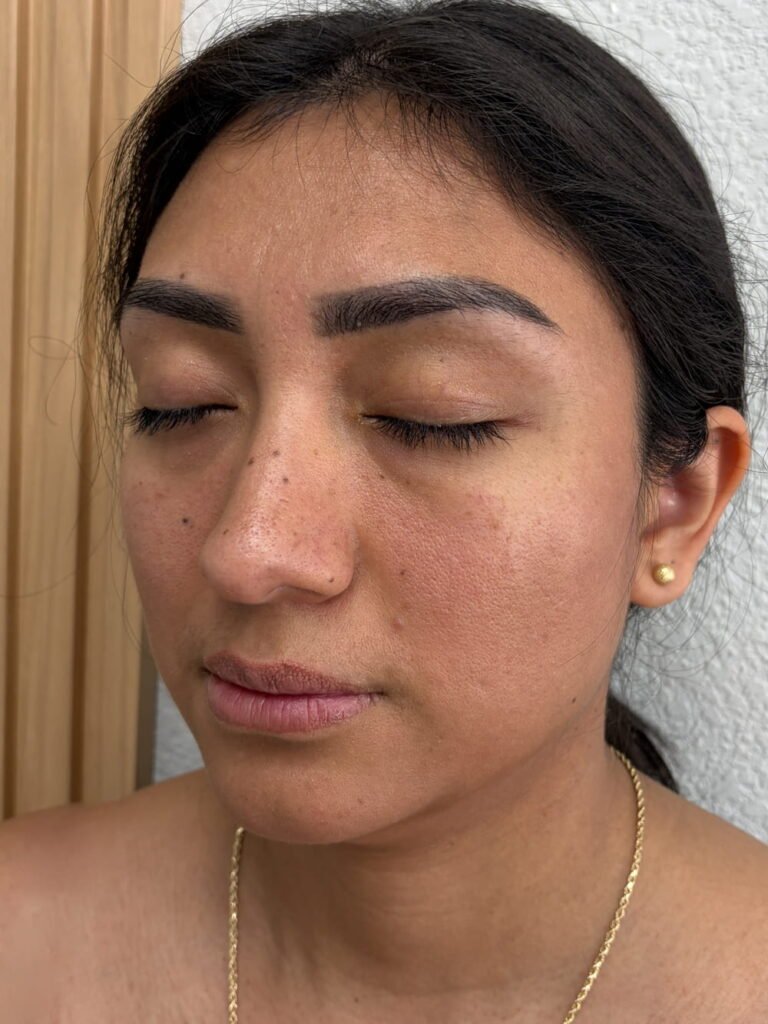 03-antes del Face balance with plasma gel