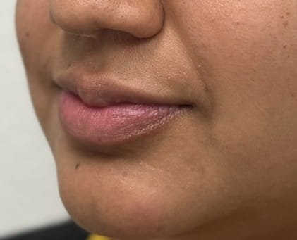 Lip filler Restylane Kysse -03-antes