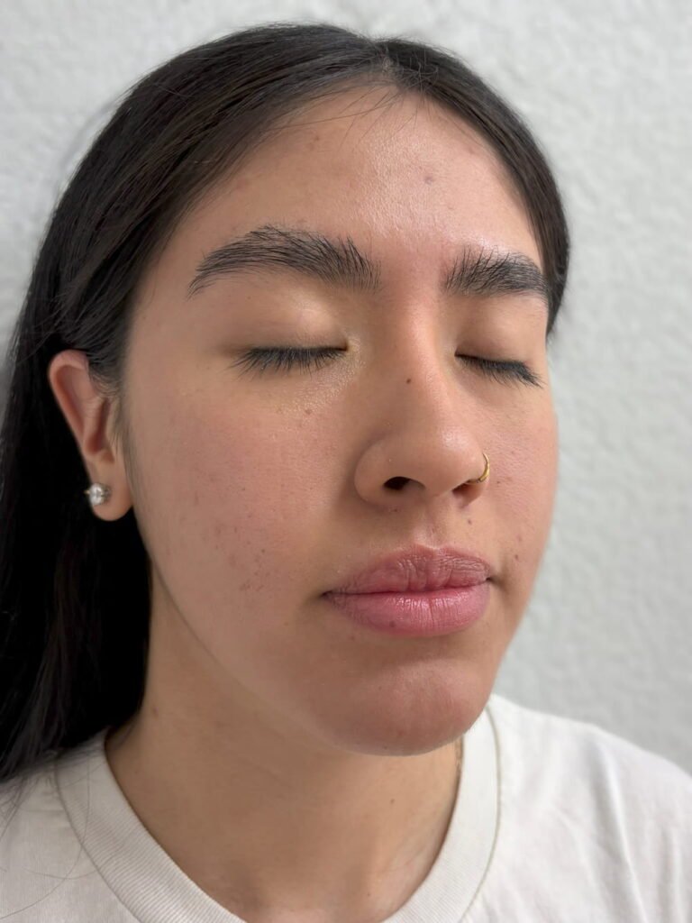 03-before signature facial chemical peel