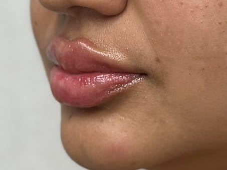 03-despues Lip filler Restylane Kysse