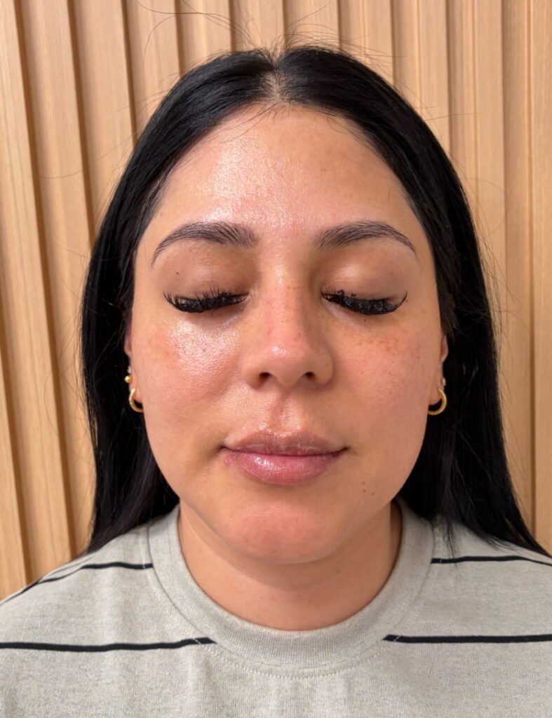 04-after Xeomin, chemical peel