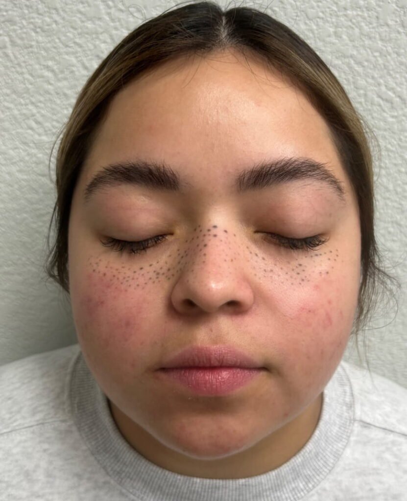 04-antes del Derma filler, xeomin, laser, adva, aerolase, VI Peel