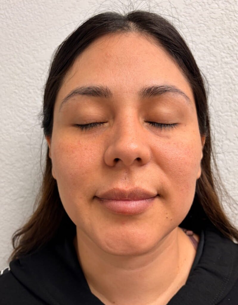 04-before Xeomin, chemical peel