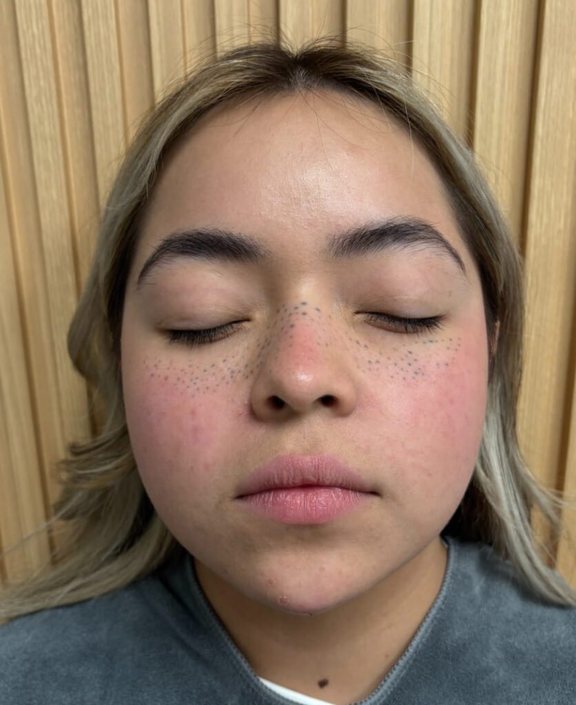 Derma filler, xeomin, laser, adva, aerolase, VI Peel