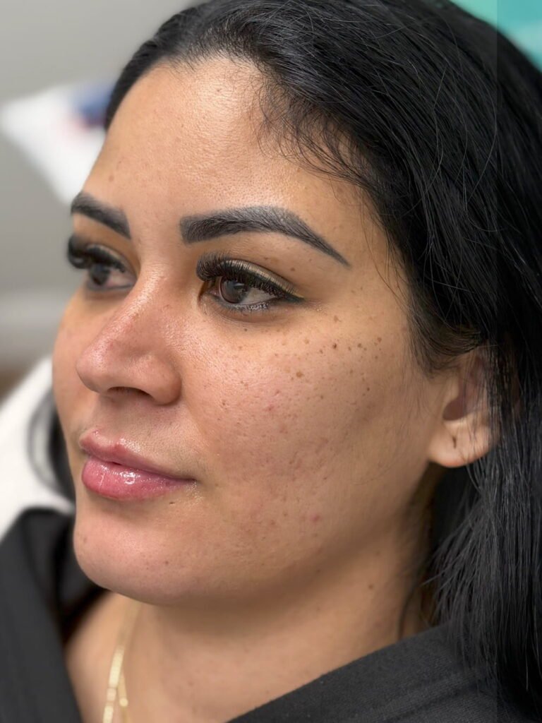 Lip filler Restylane Kysse