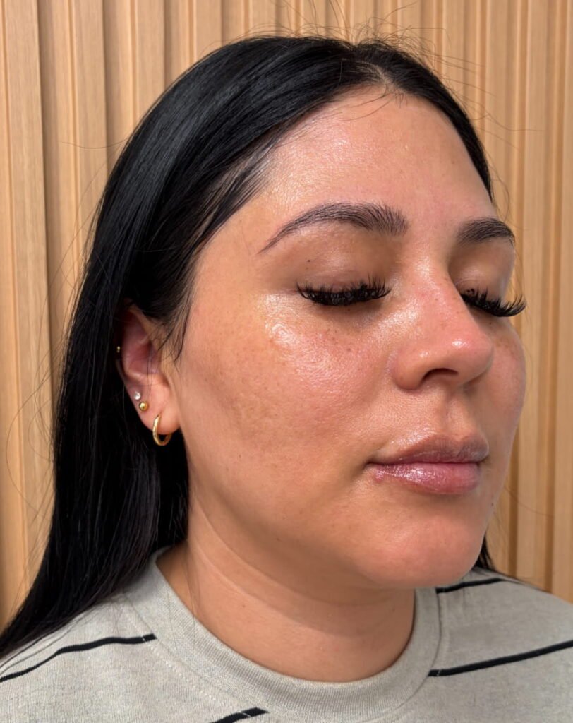 Xeomin, chemical peel