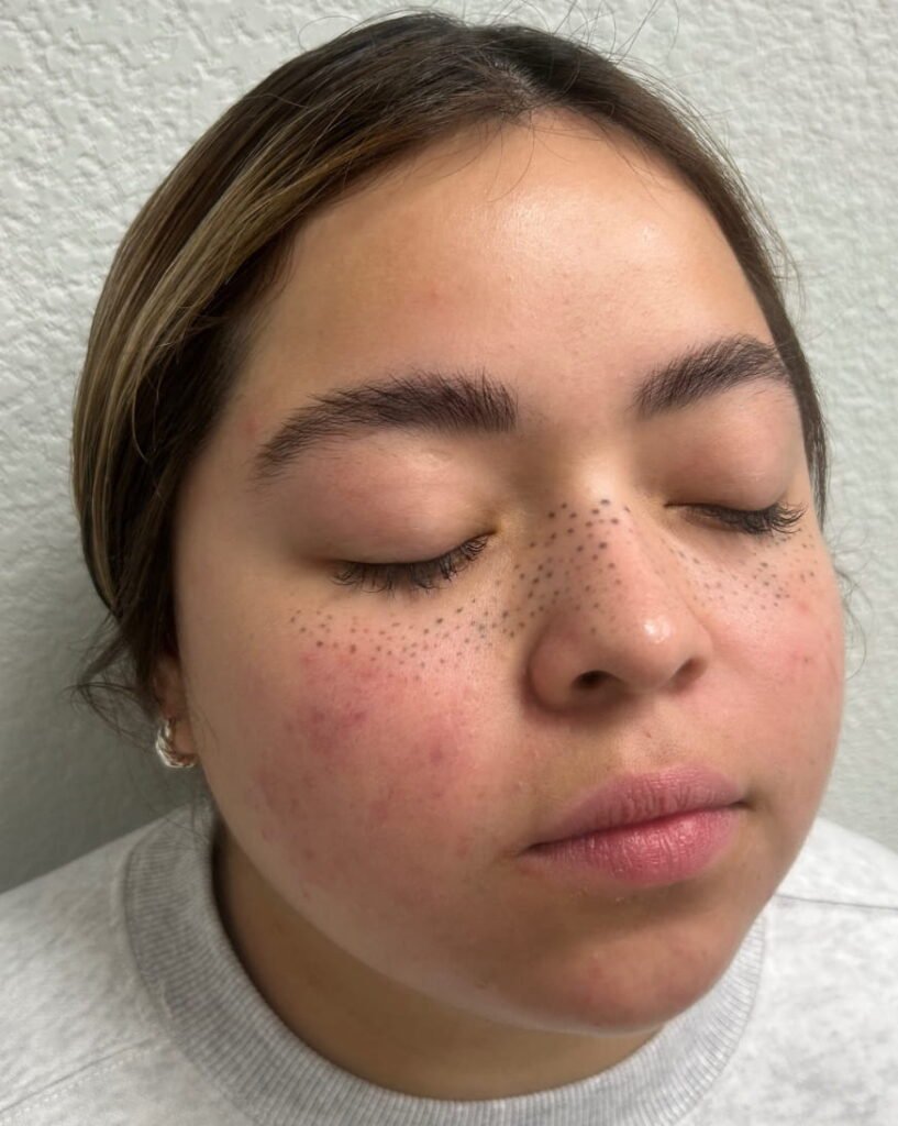 05-antes de los tratamientos Derma filler, xeomin, laser, adva, aerolase, VI Peel