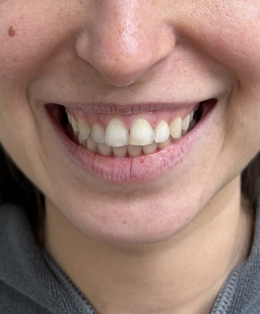 Botox lip flip, Restylane Kysse, lip filler -05-antes