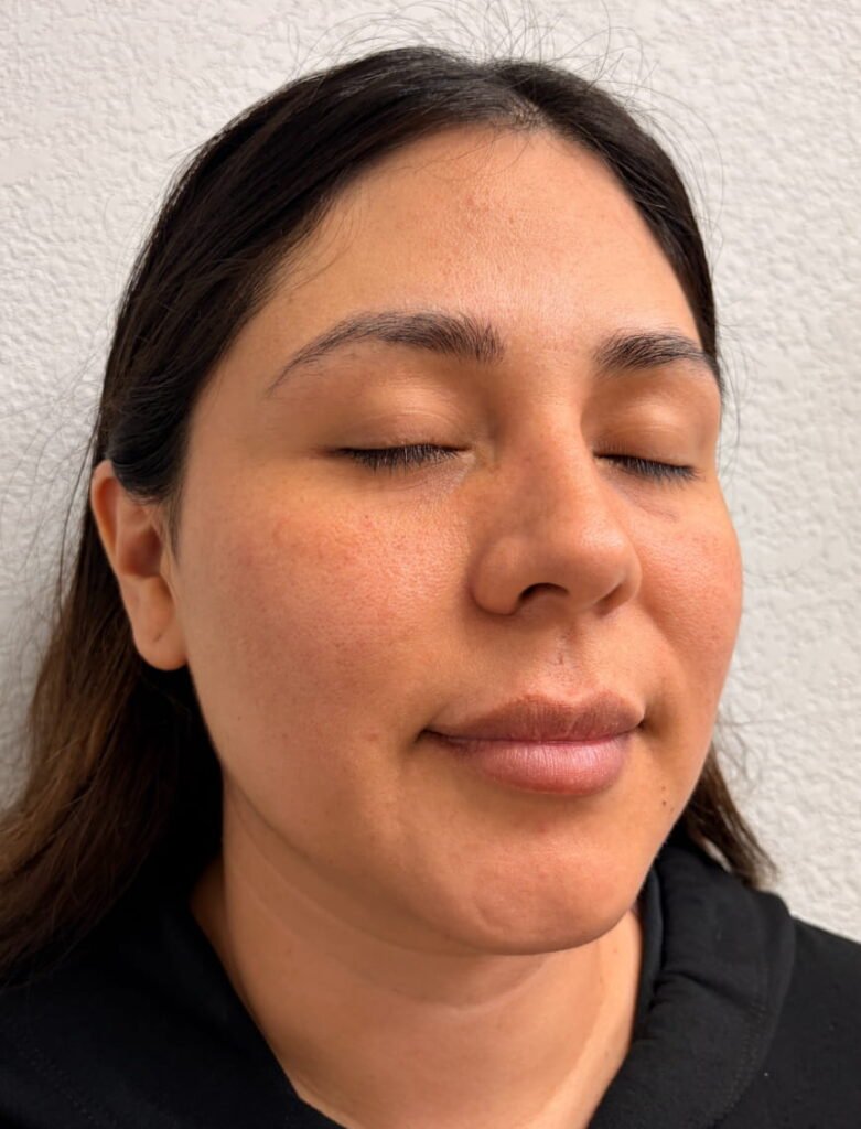05-before de tratamientos Xeomin, chemical peel