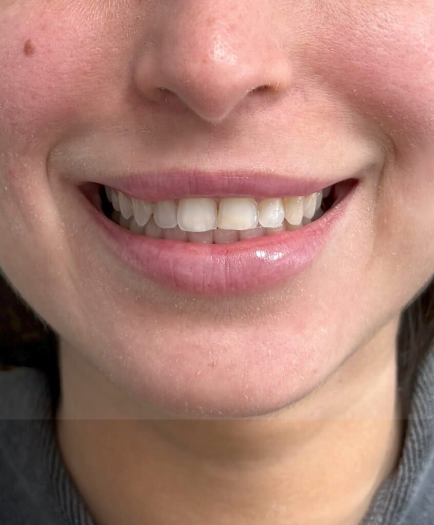05-despues Botox lip flip, Restylane Kysse, lip filler