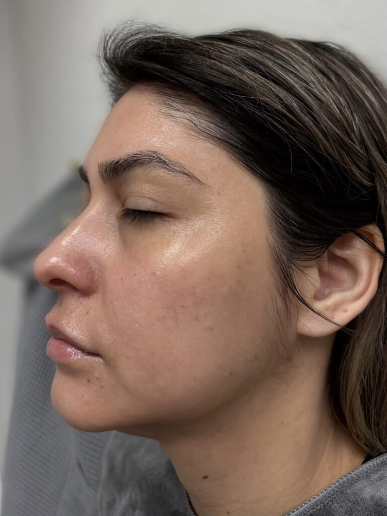 Adva laser vip peel prp
