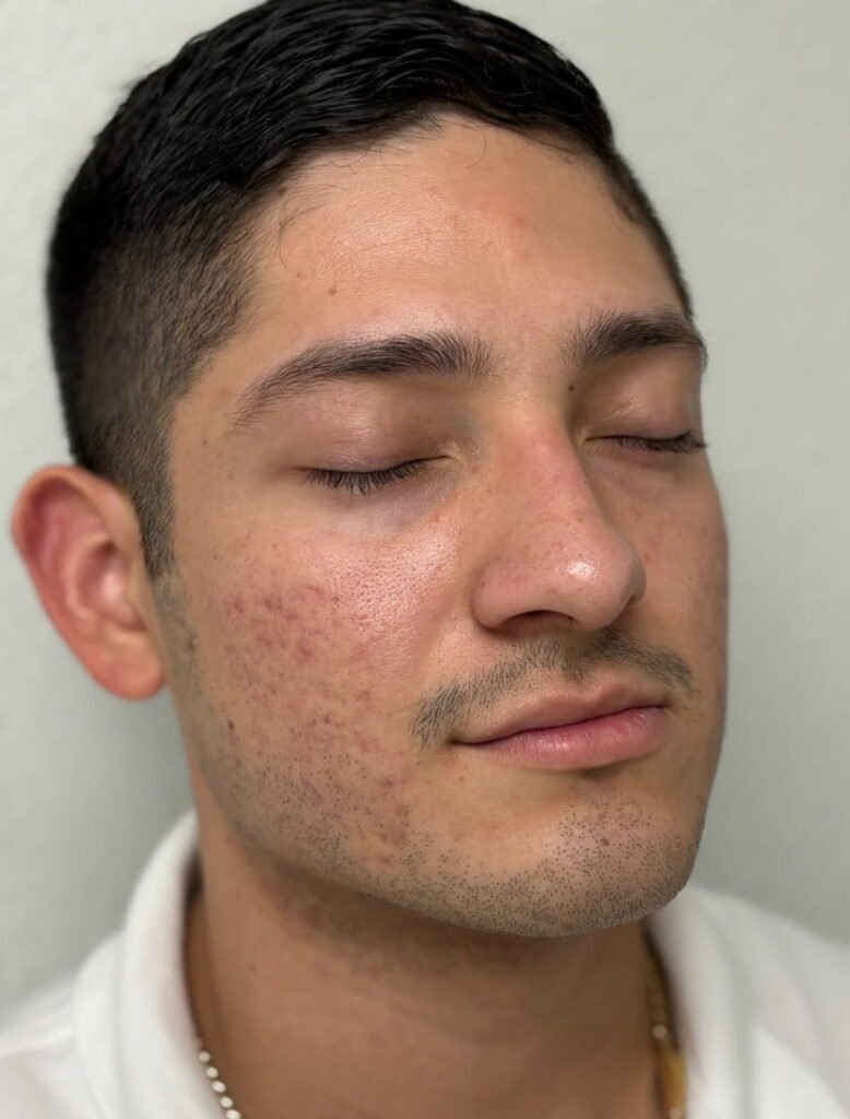 06-antes Secret Rf, Vi Peel, aerolase, exceed Microneedling