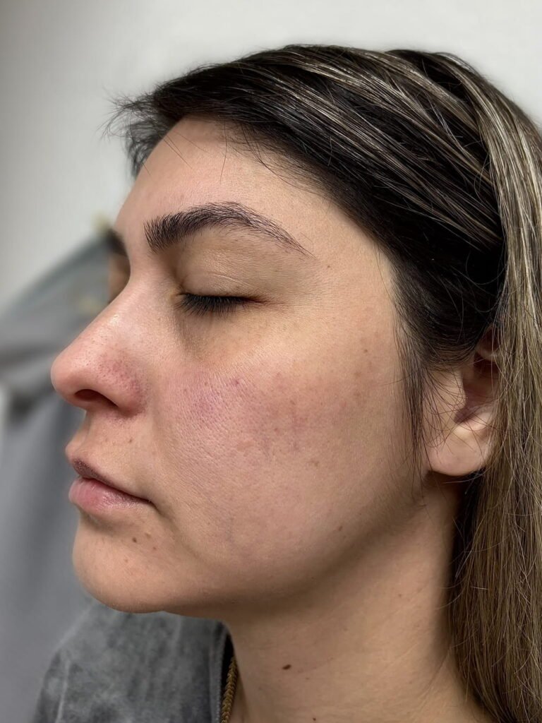 06-before .Adva laser vip peel prp